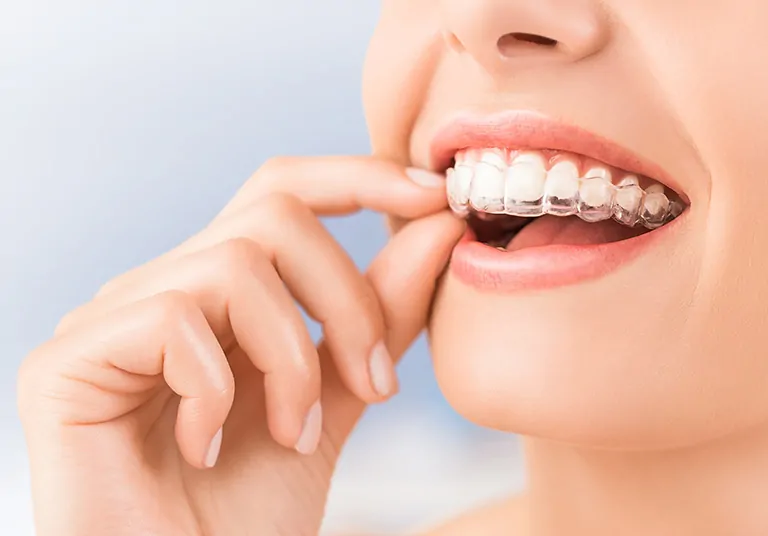 Tips To Prepare For Your Invisalign Consultation